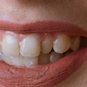 Crooked Teeth Closeup - Vondran Orthodontics