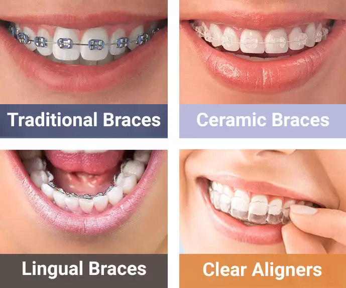 https://arkansasbraces.com/wp-content/uploads/2023/08/different-types-of-braces-metal-ceramic-lingual-and-invisible-aligner-trays-1.webp
