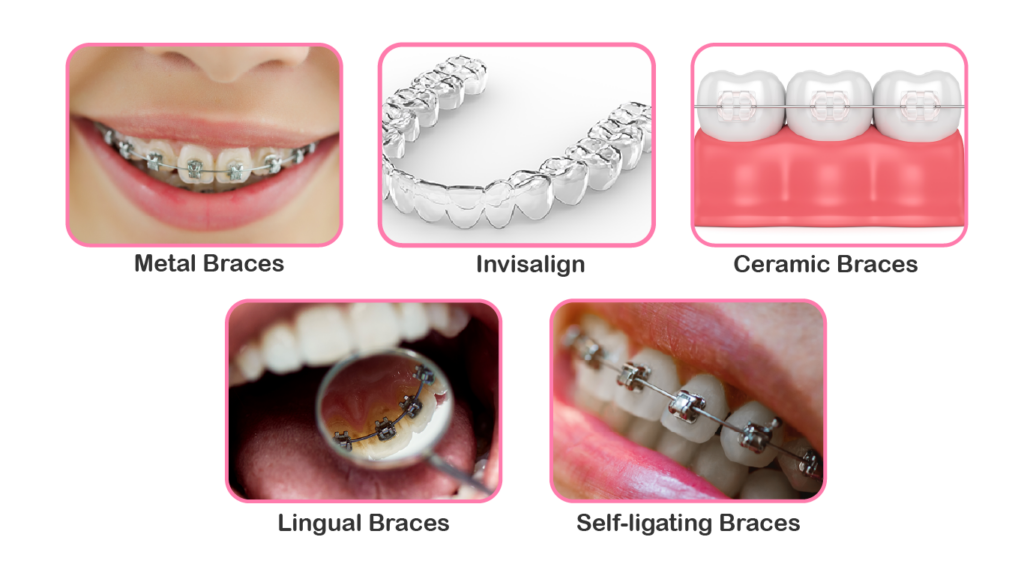 Different Types of Braces: Metal, Ceramic, Lingual, and Invisible Aligner Trays