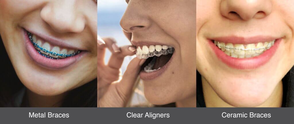 Different Types of Braces: Metal, Ceramic, Lingual, and Invisible Aligner Trays