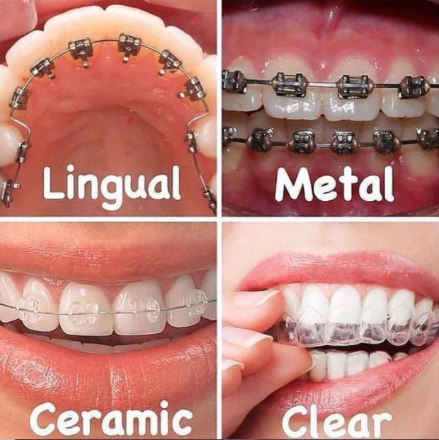 Different Types of Orthodontics