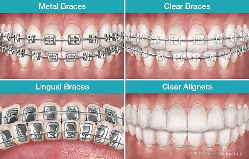 Types of Braces, Amato Orthodontics