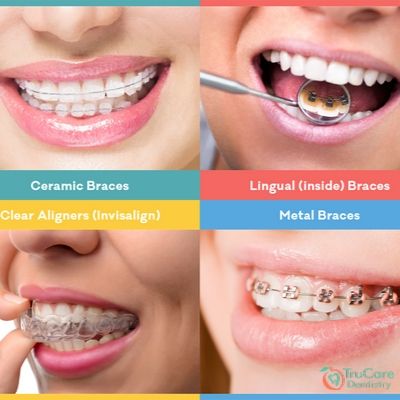 Types of Braces - Zuccala Orthodontics