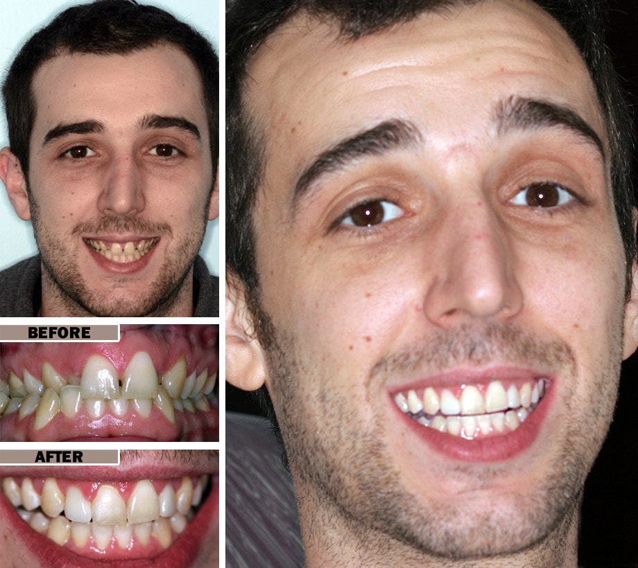 Orthodontic Treatment: How to Move Teeth Without Surgery